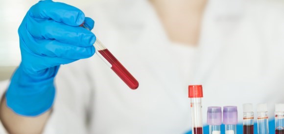 בדיקת חומצה לקטית (Lactic Acid) - תמונה